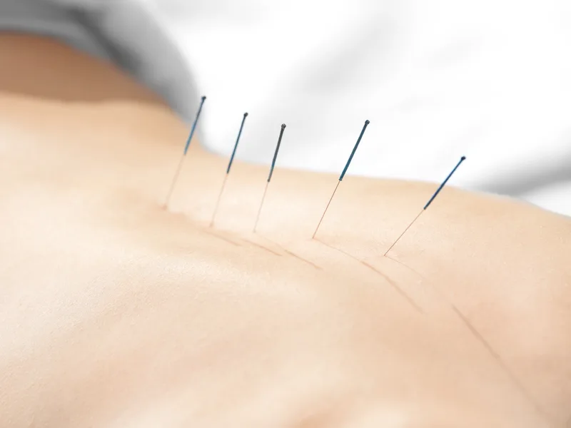 Acupuncture at Hans Chiropractic & Injury Center in Norcross