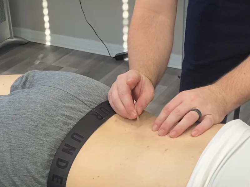 How Dry Needling works at Hans Chiropractic & Injury Center