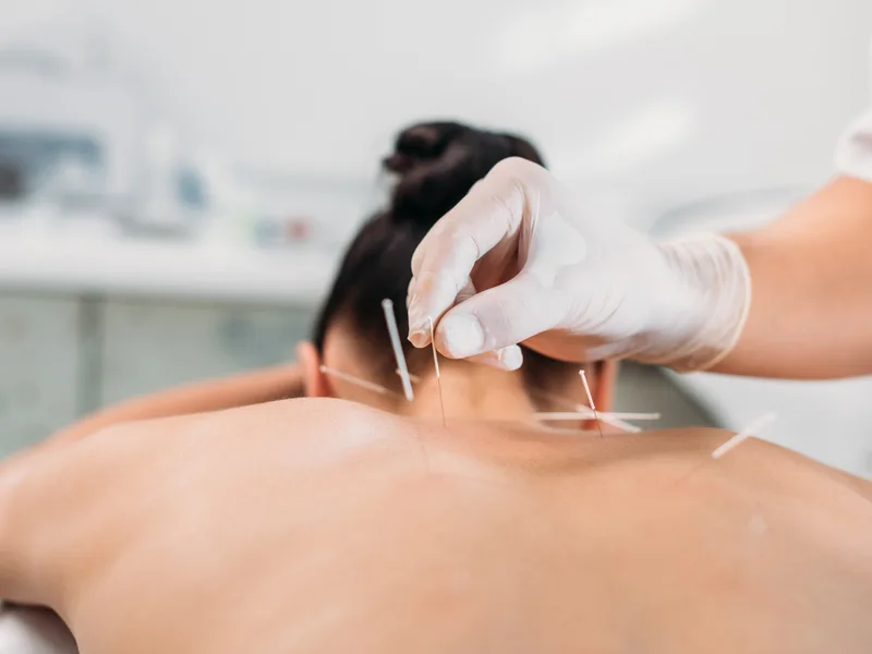 Dry Needling at Hans Chiropractic & Injury Center in Norcross
